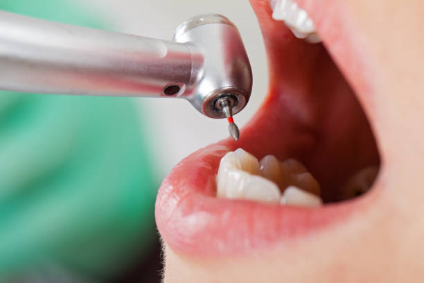 Best Emergency Wisdom Teeth Removal in Bylas, AZ